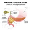 Gallbladder disease - gallstone Royalty Free Stock Photo