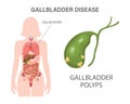 Gallbladder diseases infographic banner. Gallstone disease, cancer, cholangitis or polyps of the digestive system.