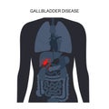 gallbladder disease poster