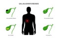 Gallbladder diseases poster