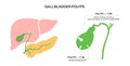 Gallbladder polyp anatomy