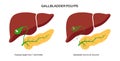 gallbladder anatomy poster