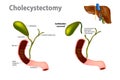 Gallbladder Removal Surgery