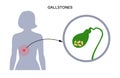 gallbladder stones anatomy