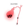 gallbladder stones anatomy Royalty Free Stock Photo