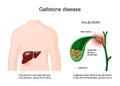 Gallstone disease. Cross section of Gallbladder with Gallstones