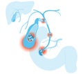 Gallstone disease. gallstones blocking bile duct and pancreatic duct. Labeled Illustration