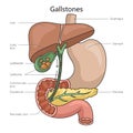 Gallstone structure diagram medical science