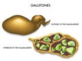 Gallstones Royalty Free Stock Photo