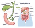 Gallstones as stones of cholesterol in gallbladder organ outline diagram