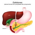 Gallstones. Parts of a digestive system: gallbladder, duodenum, stomach, liver, and pancreas Royalty Free Stock Photo