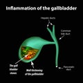 Gallstones. Cholelithiasis. Cholecystitis. Inflammation of the gallbladder. Infographics. Vector illustration