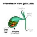 Gallstones. Cholelithiasis. Cholecystitis. Inflammation of the gallbladder.