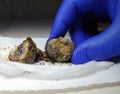 Gallstones close up. Calculi in the hands of the surgeon after laparoscopy, surgery to remove the gallbladder. Complications of Royalty Free Stock Photo