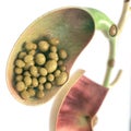 Gallstones in gallbladder and bile duct - high details - 3D rendering Royalty Free Stock Photo