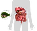 Gallstones in the Gallbladder