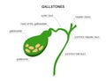gallbladder stones anatomy Royalty Free Stock Photo