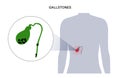 gallbladder stones anatomy