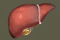 Gallstones, illustration showing front view of liver and gallbladder with stones