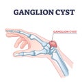 Ganglion cyst as tendon fluid filled swelling near arm joint outline diagram