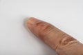 Ganglion Cyst on finger