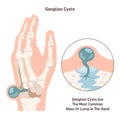 Ganglion cyst. Fluid-filled lump under the skin of a wrist or hand. Synovial