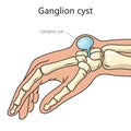 Ganglion cyst structure diagram medical science