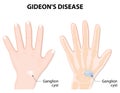 Ganglion cyst or synovial cyst