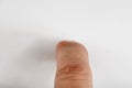 Ganglion Cysts on finger