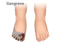 Gangrene is a type of tissue death caused.