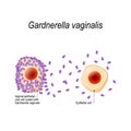 Gardnerella vaginalis. Vaginal epithelial clue cell coated with bacteria