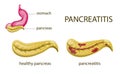 Gaster and pancreatitis