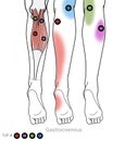 Gastocnemius calf muscle myofascial trigger points