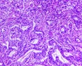 Gastric adenocarcinoma of a human Royalty Free Stock Photo