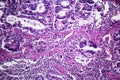 Gastric adenocarcinoma, light micrograph