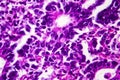 Gastric adenocarcinoma, light micrograph