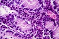 Gastric adenocarcinoma, light micrograph