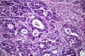 Gastric adenocarcinoma, light micrograph