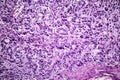 Gastric adenocarcinoma, light micrograph