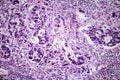 Gastric adenocarcinoma, light micrograph