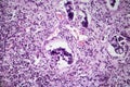 Gastric adenocarcinoma, light micrograph