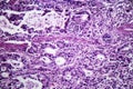 Gastric adenocarcinoma, light micrograph