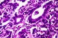 Gastric adenocarcinoma, light micrograph