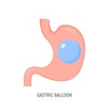 Gastric balloon weight loss intragastric surgery. Stomach gastric balloon operation vector icon