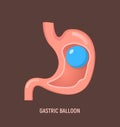 Gastric balloon weight loss intragastric surgery. Stomach gastric balloon operation vector icon