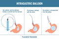 Gastric balloon weight loss procedure phases shown in stomach