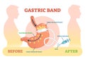 Gastric Band anatomical vector illustration diagram, medical before after scheme. Royalty Free Stock Photo