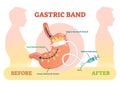 Gastric Band anatomical vector illustration diagram, medical before after scheme.