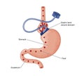 Gastric band operation