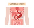 Gastric band poster Royalty Free Stock Photo